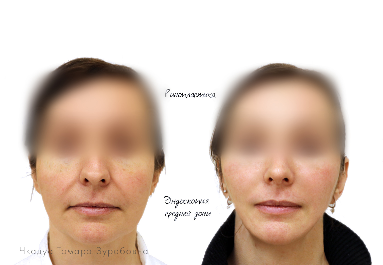 Комки биша на схеме лица. Подтяжка лица пластика. Лифтинг периорбитальной зоны комки Биша.